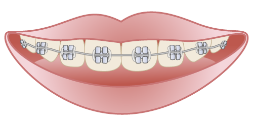 ブラケット（ワイヤー）矯正の場合